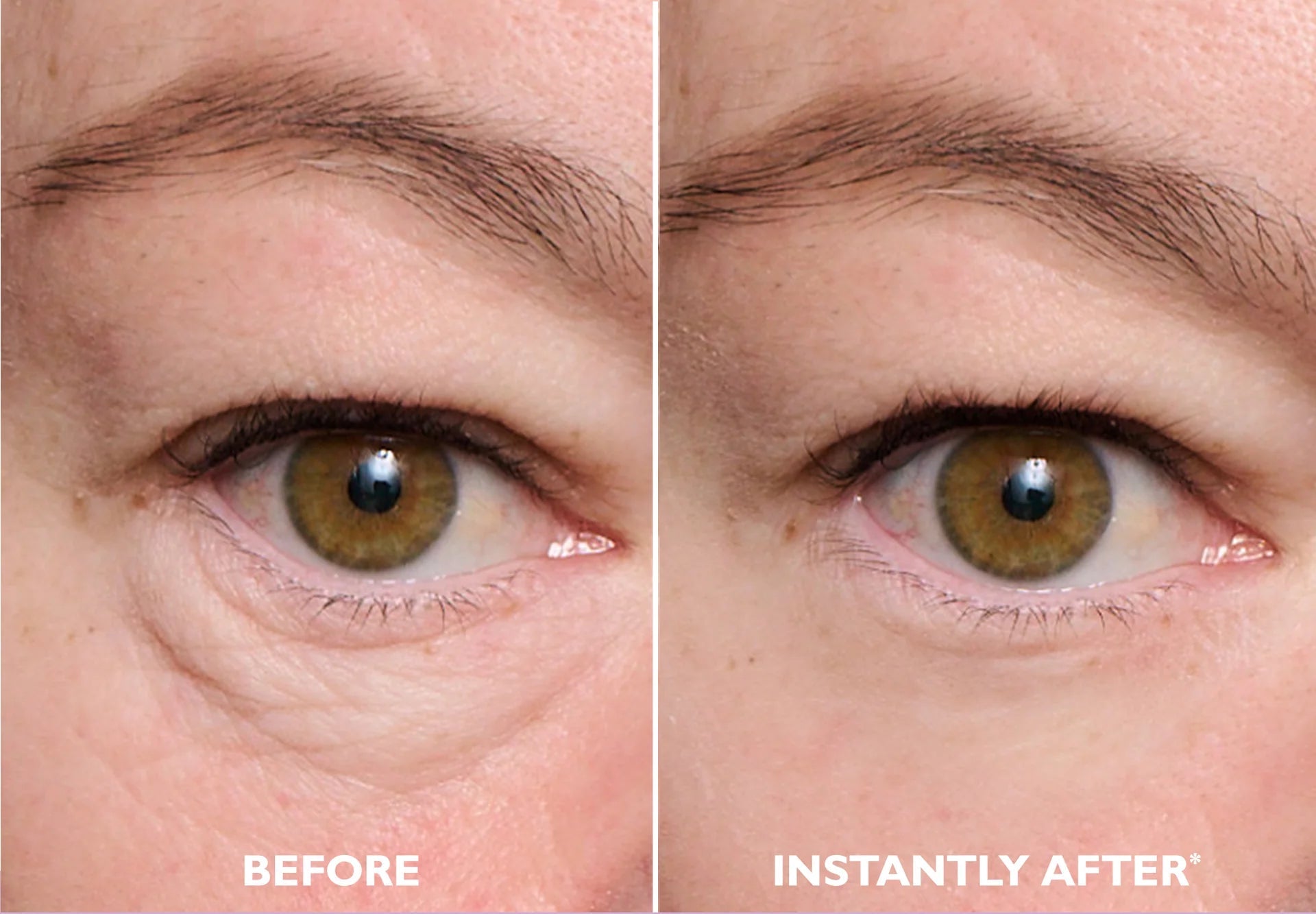 Temporary Eye Tightener