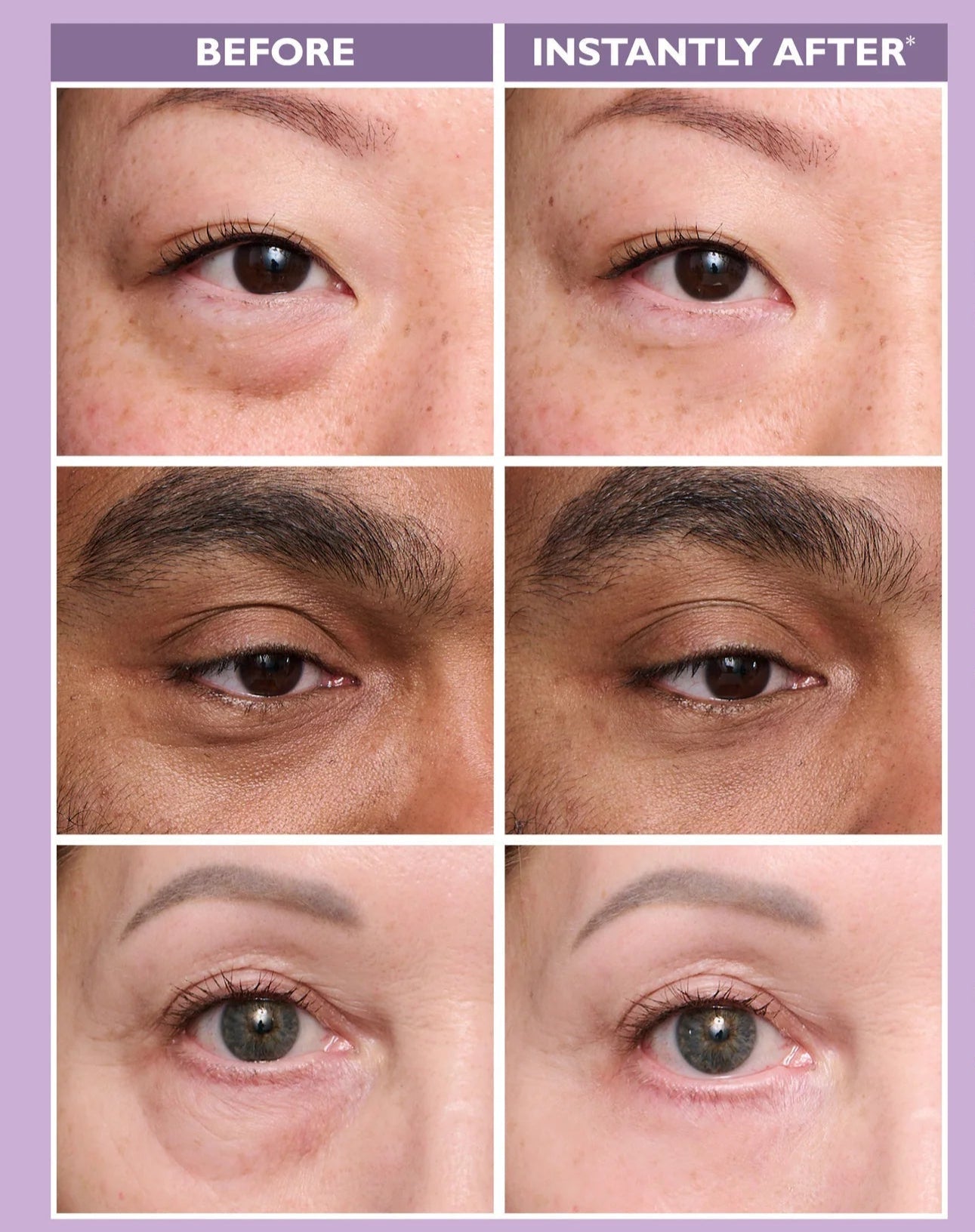 Temporary Eye Tightener