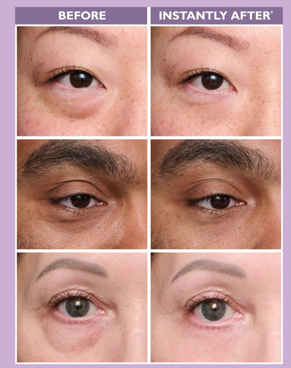Temporary Eye Tightener